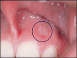 oral-cancer-pic1