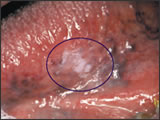 oral-cancer-pic1